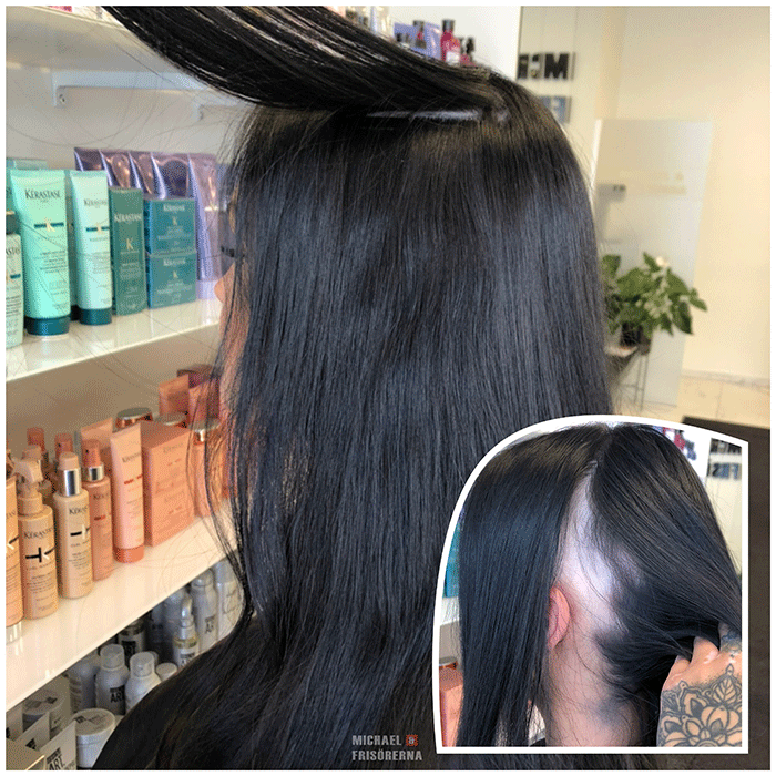 alopecia